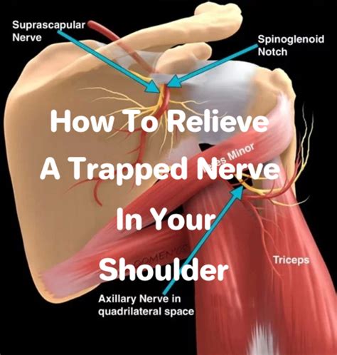 The Ultimate Guide To Pinched Nerve In Neck Causing Shoulder Pain