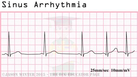 Respiratory Sinus Arrhythmia