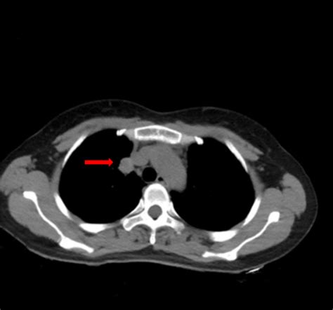 Chest Computed Tomography Showed A 21 × 17 Cm Well Defined Round Mass