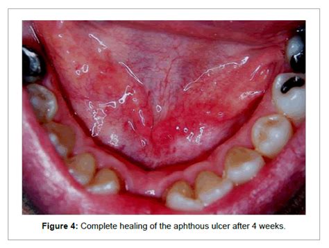 Ulcer On Floor Of Mouth