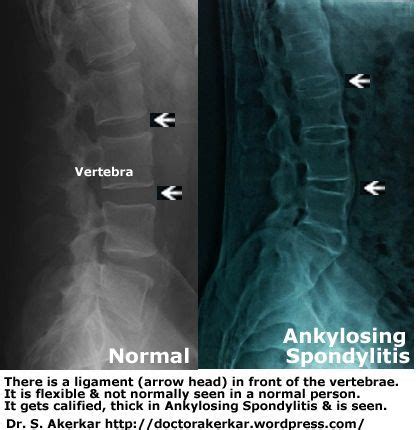These provide images of dense structures, such as bone. ankylosing spondylitis x ray | Xrays | Pinterest ...