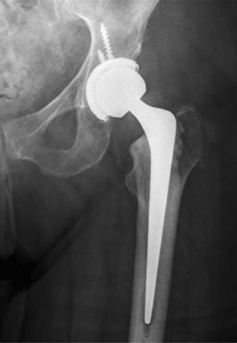Hip Replacement Orthopaedics And Trauma London