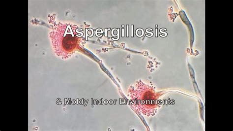 Aspergillosis And Moldy Indoor Environments Youtube