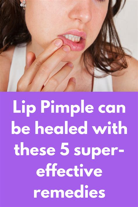 Lip Pimple Can Be Healed With These 5 Super Effective Remedies A Pimple