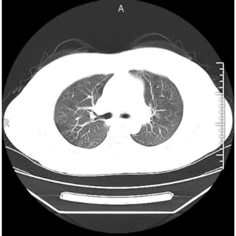 Chest Ct Scans Showed No Significant Abnormalities Download
