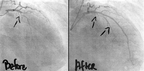 Ct Coronary Angiogram 4 Reasons Why It Is Done Pulse Cardiology