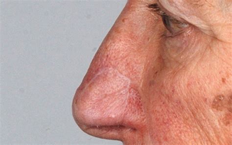 Medical First As Noses Are Regrown Nose Medical Skin