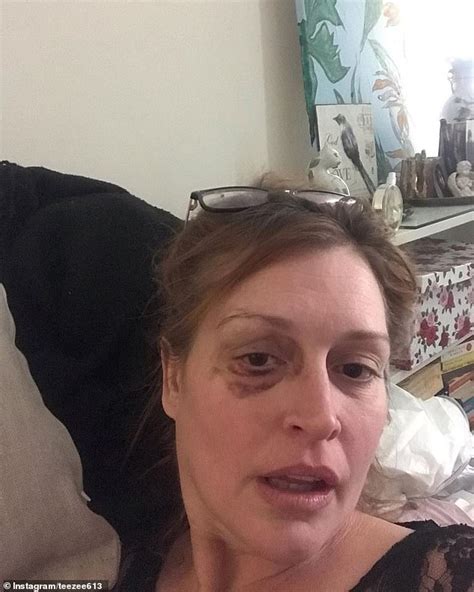 tziporah malkah sparks concerns as she shares confronting photograph with huge black eye daily