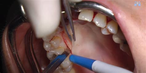 Connective Tissue Harvesting From The Palate Video Pgedu