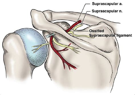 Figure 3 From Ossification Of The Suprascapular Ligament A Risk Factor