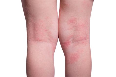 12 Common Skin Rashes In Children And Their Treatments