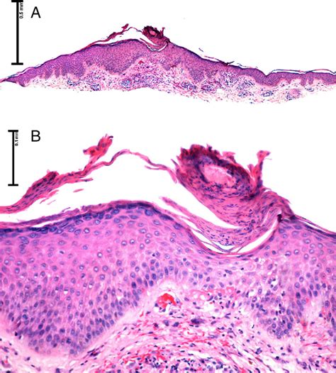 A Panoramic Image Showing An Oblique Layer Of Parakeratosis On An