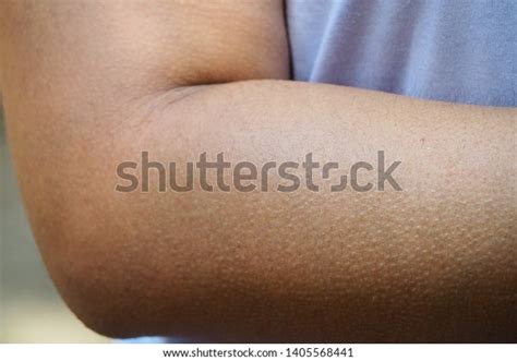 Стоковая фотография 1405568441 Human Skin Getting Goosebumps On Arm