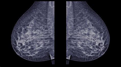 2d Or 3d Mammograms Whats The Best Breast Screening Exam