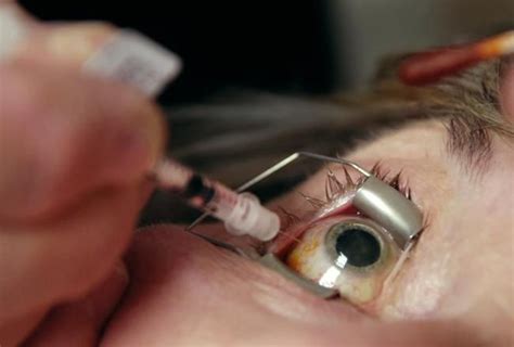 Injections For Wet AMD Eyes Problems Eye Care Macular Degeneration