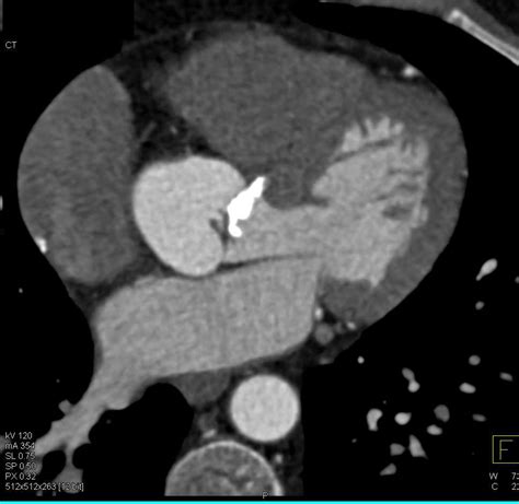 Aortic Stenosis With Extensive Aortic Valve Calcification Cardiac