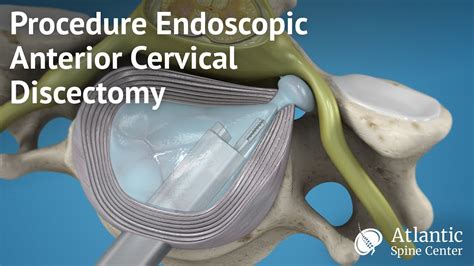 Procedure Endoscopic Anterior Cervical Discectomy Youtube Cervical My