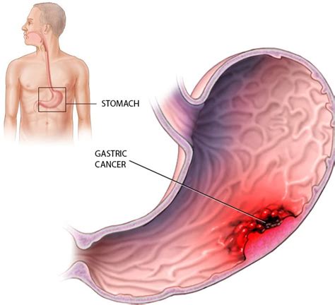 However, these symptoms may not appear for many years as stomach cancers grow very slowly. Gastric Cancer - South Florida Sugical Oncology