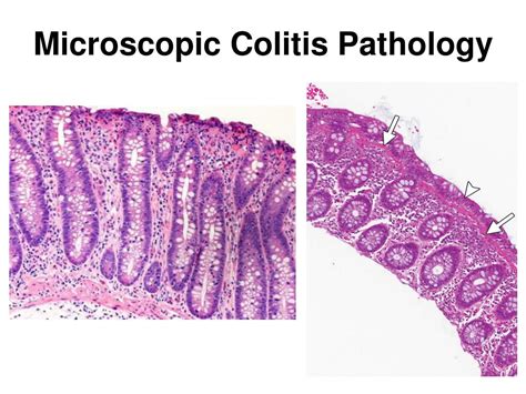Ppt How Do We Make The Diagnosis Of Ibd And Microscopic Colitis