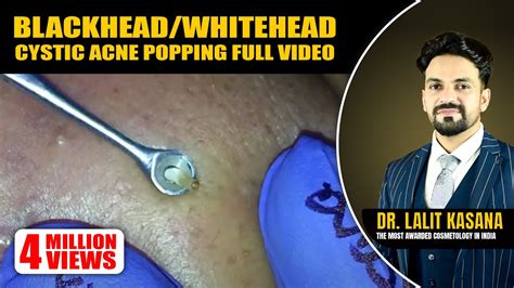 Blackheadwhiteheadcystic Acne Popping Full Video Youtube