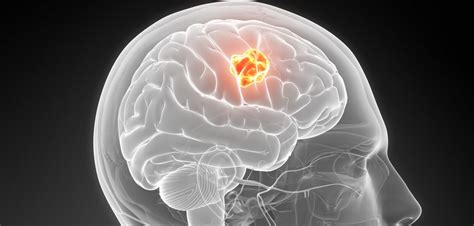 Aggressive Growth Of Common Brain Tumors Linked To Single Gene Cancer