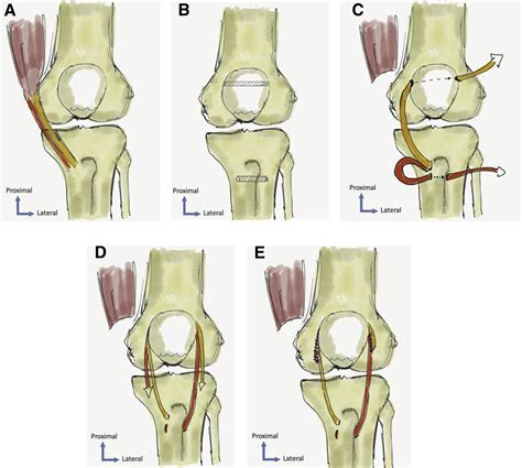 Patella Distal Pole Fracture Treated Using Ipsilateral Hamstring