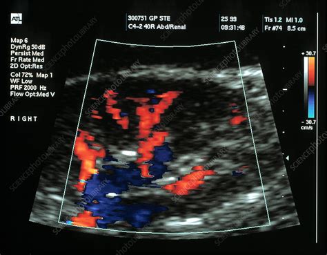 Transplanted Kidney Doppler Ultrasound Stock Image M1950087