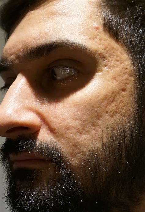 Platelet rich plasma (prp) is an exciting new method using your own blood to correct pitted acne scars on the skin. Subsicion, PRP, Dermapen, TCA cross for acne scars - Page ...