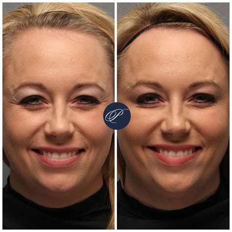 Botox Smile Lift A Guide To A More Confident Smile In 2023 Webpt