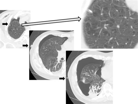 Figure3chest Plain Computed Tomography Ct Findings Soon After Lung