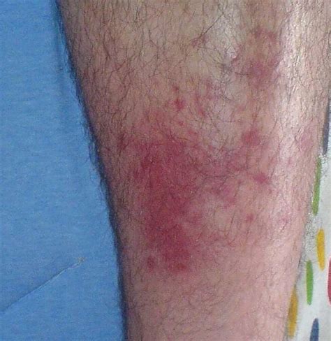 Cellulitis From Bug Bites Signs Symptoms And Treatment