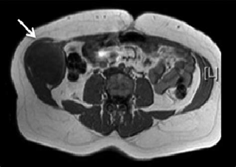 T1 Mri Showing A Soft Tissue Abdominal Wall Tumour Involving External