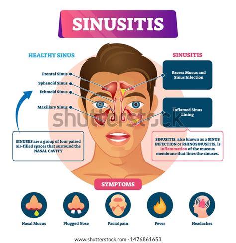 Sinusitis Vector Illustration Labeled Rhinosinusitis Inflammation