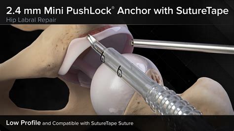 Arthrex 2 4 Mm Mini Pushlock® Anchor With Suturetape Hip Labral Repair