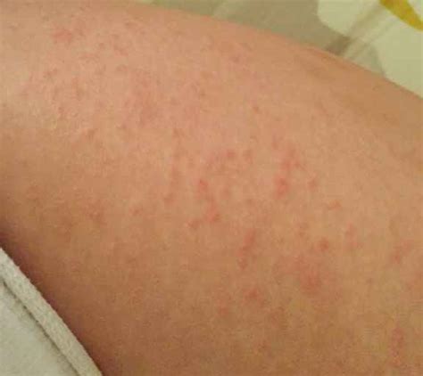 Itchy Bumps On Arms Pictures Symptoms Causes Treatment Bank Home The Best Porn Website