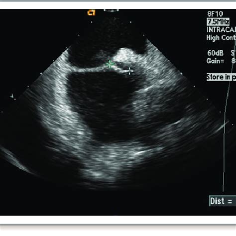 Intracardiac Echocardiogram Showing A Patent Foramen Ovale Pfo With A