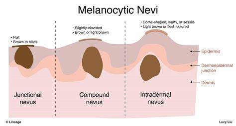 Nevus Dermatology Medbullets Step 1