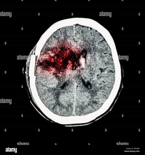 Ct Scan Of Brain Show Old Right Basal Ganglia Hemorrhage With Brain