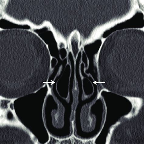 Sagittal View Showing The Types And Degree Of Sphenoid Sinus