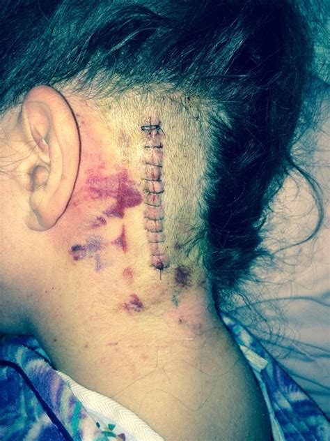 My Mvd Surgical Incision Occipital Neuralgia Glossopharyngeal