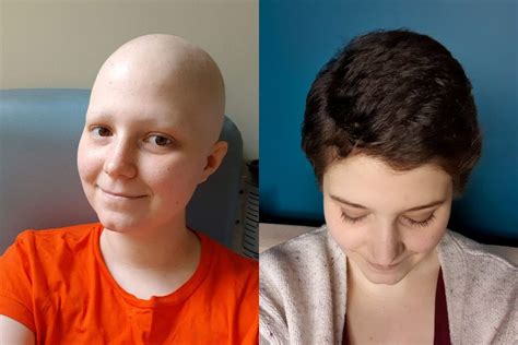 Top 100 Image Hair Growth After Chemo Vn