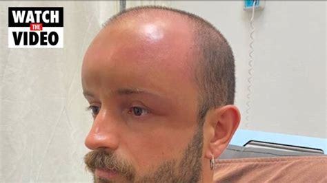 Doctors Stunned By Mans Swollen Head After Day At Beach The Advertiser