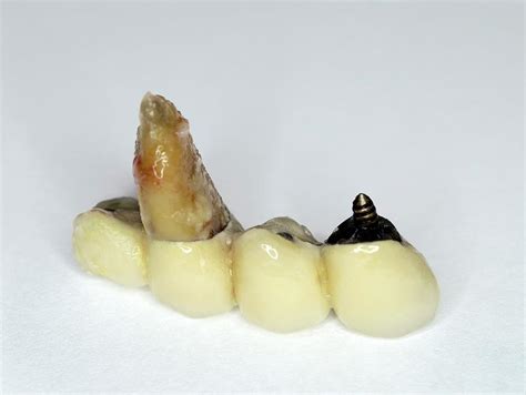 Extracted Tooth With Bridge Photograph By Dr Armen Taranyan Science