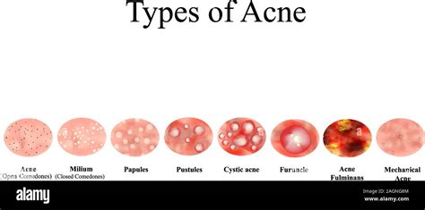 Types Of Acne Skin Inflammation Pimples Boils Whitehead Closed