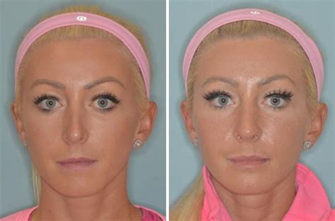 Revision Rhinoplasty Photos Dr Anthony Bared Md Facial Plastic