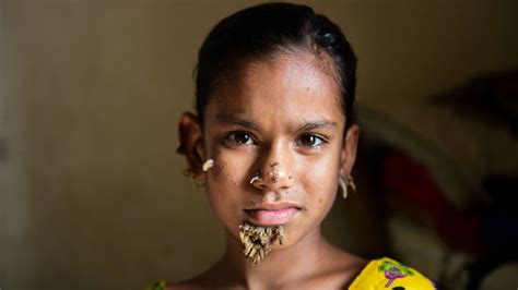 Bangladeshi Girl May Be First Female With Tree Man Syndrome Bbc News
