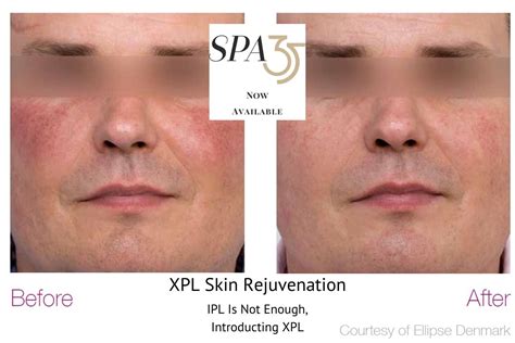 Ipl Treatment In Boise Idaho Age Spots Redness Reduction — Spa 35