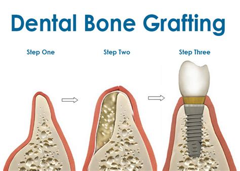 Bone Graftingvancouver General Dentistry Dr David Huh Four