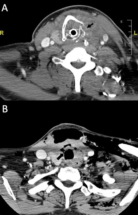 Delayed Tracheal Perforation After Partial Thyroidectomy A Case Report