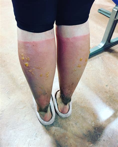 This Runner Suffered From Extreme Sunburn After Neglecting To Reapply Sunscreen On Her Legs Allure